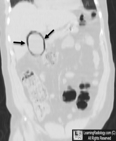 Emphysematous Cholecystitis